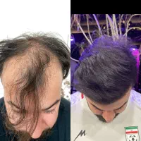 کاشت مو پرتراکم باکیفیت عالی و دائمی