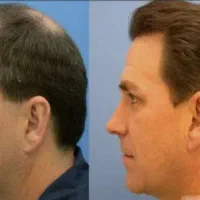 کاشت موی طبیعی و تضمینی، تزریق ژل و بوتاکس