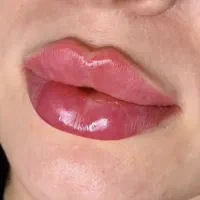 مدل فیلر و بوتاکس