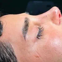 جراحی بادی توسط متخصص پلاستیک نمونه کار تلگرام