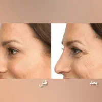 کرم بوتاکس|آرایشی، بهداشتی، درمانی|مراغه, |دیوار