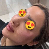 ژل و بوتاکس مزوتراپی و مزونیدلینگ آرایش دایم