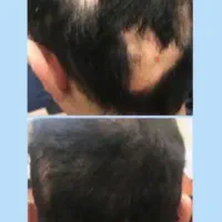 ریزش سکه ای رویش مو و ریش