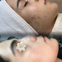 فشیال تخصصی مزونیدلینگ PRP با بهترین روش و متریال