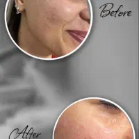 درمان پوست باتخفیف بلک فرایدی/پوست کره‌ای/کاموفلاژ|خدمات آرایشگری و زیبایی|پاکدشت, پاکدشت (مامازند)|دیوار