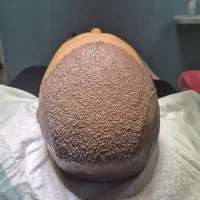 کاشت مو  ۹۸۰۰