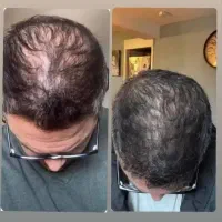 درمان ریزش مو