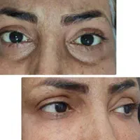 فیلر شقیقه فیلر زیر چشم نخ لیفت ابرو و چشم گربه ای|خدمات آرایشگری و زیبایی|قم, زنبیل آباد|دیوار