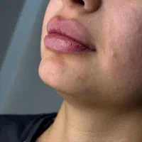 تزریق فیلر لب رایگان