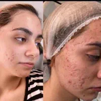 ٪۳۰ تخفیف فشیال و پاکسازی پوست و صورت در کلینیک|خدمات آرایشگری و زیبایی|قم, پردیسان|دیوار