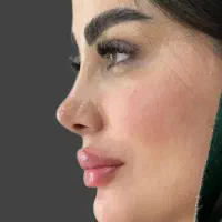 جراحی بینی ۲۹ میلیون فقط ۸ اذر|خدمات آرایشگری و زیبایی|قم, بکایی|دیوار