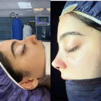 عمل بینی ۳۳ ابدو ۶۵ لیفت صورت شقیقه اسلیو