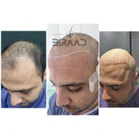 کاشت مو ، ریش ، ابرو