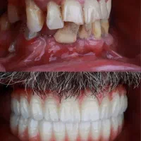 جشنواره تخفیف ایمپلنت در تبریز،با روکش فقط ۱۶تومن|خدمات آرایشگری و زیبایی|خوی, |دیوار