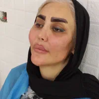 تزریق چربی صورت\فیلرلب/فیلربادی/بوکالفت/غبغب|خدمات آرایشگری و زیبایی|تهران, عبدلآباد|دیوار