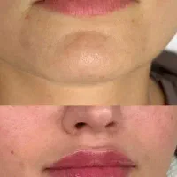 تزریق تخصصی ژل، بوتاکس، مزو