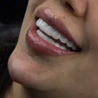 کامپوزیت ولمینت اقساط