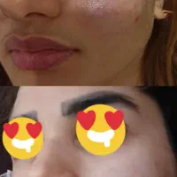 تزریقات تخصصی ژل و بوتاکس|خدمات آرایشگری و زیبایی|اهواز, شهرک دانشگاه|دیوار