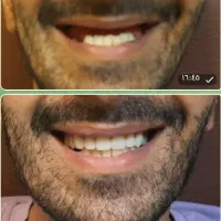 تعویض دندان مصنوعی قدیمی با دندان مصنوعی نو|آرایشی، بهداشتی، درمانی|شهرکرد, |دیوار