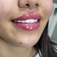 بوتاکس و پک اقتصادی زیبایی