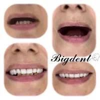 دندان مصنوعی تخفیف تا شب یلدا برای ۵ نفر قیمت ویژه|آرایشی، بهداشتی، درمانی|تبریز, |دیوار