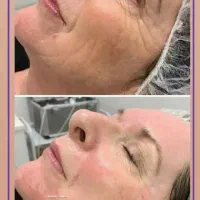 prp پی ارپی ژل فیلر بوتاکس نخ لیزر فیشیال هایفو|خدمات آرایشگری و زیبایی|مشهد, هفت تیر (حافظ)|دیوار