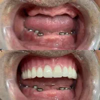 دندانپزشکی و شرایط اقساطی بدون بهره ایمپلنت