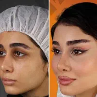 بلفاروپلاستی آلمانی لیفت ابرو لیفت شقیقه اندولیفت