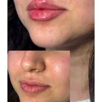 به مدل فیلر لب ، چونه ،گونه ، زاویه سازی نیازمندیم