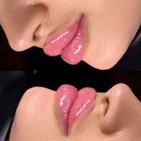 جشنواره بوتاکس فول فیس زاویه سازی ژل لب گونه چانه