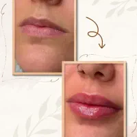تزریق فیلر و بوتاکس توسط پزشک با تخفیف ویژه|خدمات آرایشگری و زیبایی|اراک, |دیوار
