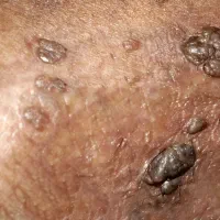 hpv (زگیل تناسلی)