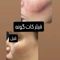 ژل فیلرسیسی(۸۲۰ لب.۸۰۰صورت)آقایان و بانوان|خدمات آرایشگری و زیبایی|زاهدان, |دیوار