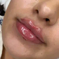 خدمات تخصصی ژل و بوتاکس و مزو