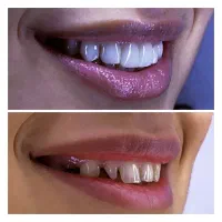 کامپوزیت/ اطفال/عصب کشی/اقساط