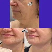 تزریق ژل و بوتاکس-چربی|خدمات آرایشگری و زیبایی|اهواز, کیانپارس |دیوار