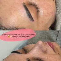 اموزش.ژل وبوتاکس ،مزوژل درمان لک تضمینی