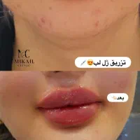 خدمات زیبایی رایگان،فیلر بوتاکس مزو ژل توسط متخصص