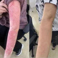 درمان تضمینی پیسی و پسوریازیس