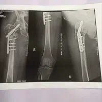 فیزیوتراپی در منزل