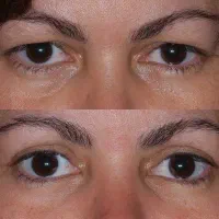 درمان افتادگی پلک