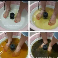 سم زدایی بدن از طریق کف پا با دستگاه یون تراپی