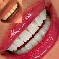 دندانپزشکی و کامپوزیت با شرایط ویژه