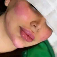 ژل و بوتاکس