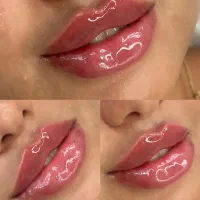 بوتاکس ژل فیلر پی ارپی فول فیس پزشک انزیم اموزش