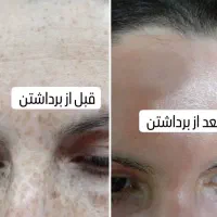 با یک جلسه کک و مکا حذف کن|خدمات آرایشگری و زیبایی|خرم‌آباد, |دیوار