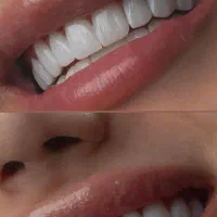 خدمات تخصصی زیبایی دندان|خدمات آرایشگری و زیبایی|بندر کنگان, |دیوار