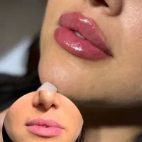 خدمات ژل و بوتاکس کره اصل