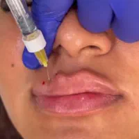 کلینیک تزریق ژل لب روسیm مادلینگ mdبوتاکس لیزر