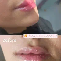 تخفیفات روزمادر تزریق ژل بوتاکس،مزوتراپی،فیلر بادی|خدمات آرایشگری و زیبایی|قم, باسکول|دیوار